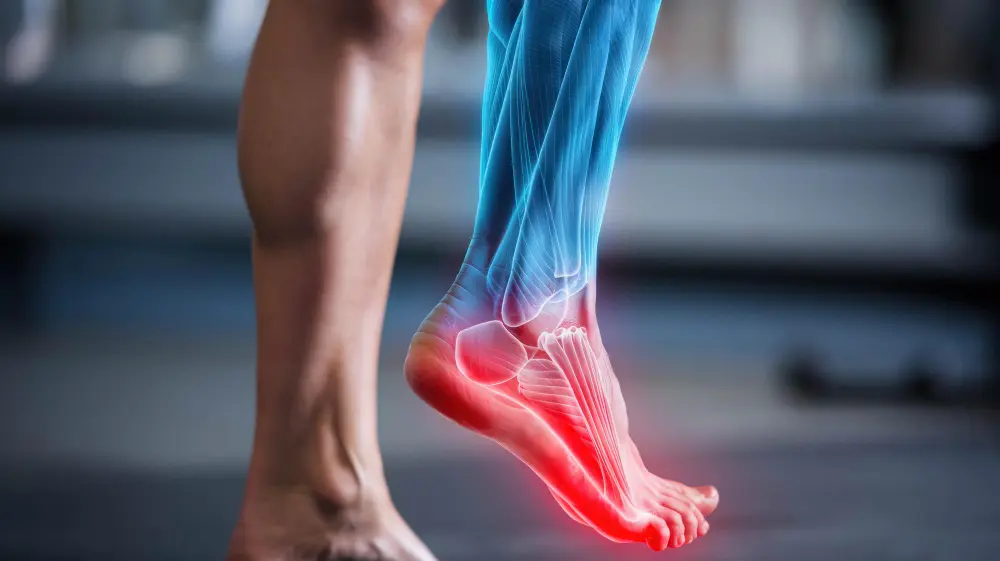 Classic Plantar Fasciitis